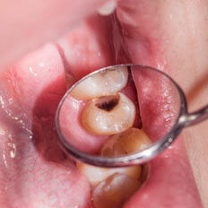 img-Large-Cavities