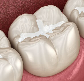 img-What-Is-A-Dental-Filling
