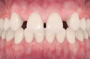 TruSmile-Dental-Missing-teeth_img