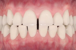 TruSmile-Dental-Spacing_img