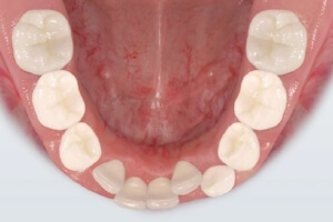 TruSmile-Dental-Tooth-Loss_img