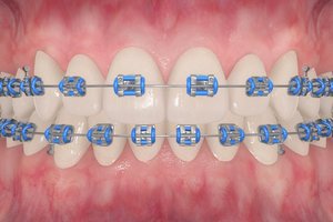 TruSmile-Dental-Treatment-Braces_img