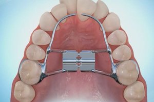 TruSmile-Dental-Treatment-Expanders_img