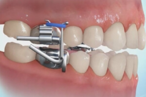 TruSmile-Dental-Treatment-Growth-Modification_img