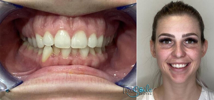 Composite-Fillings-Before