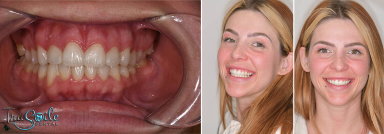 Composite-Fillings-after