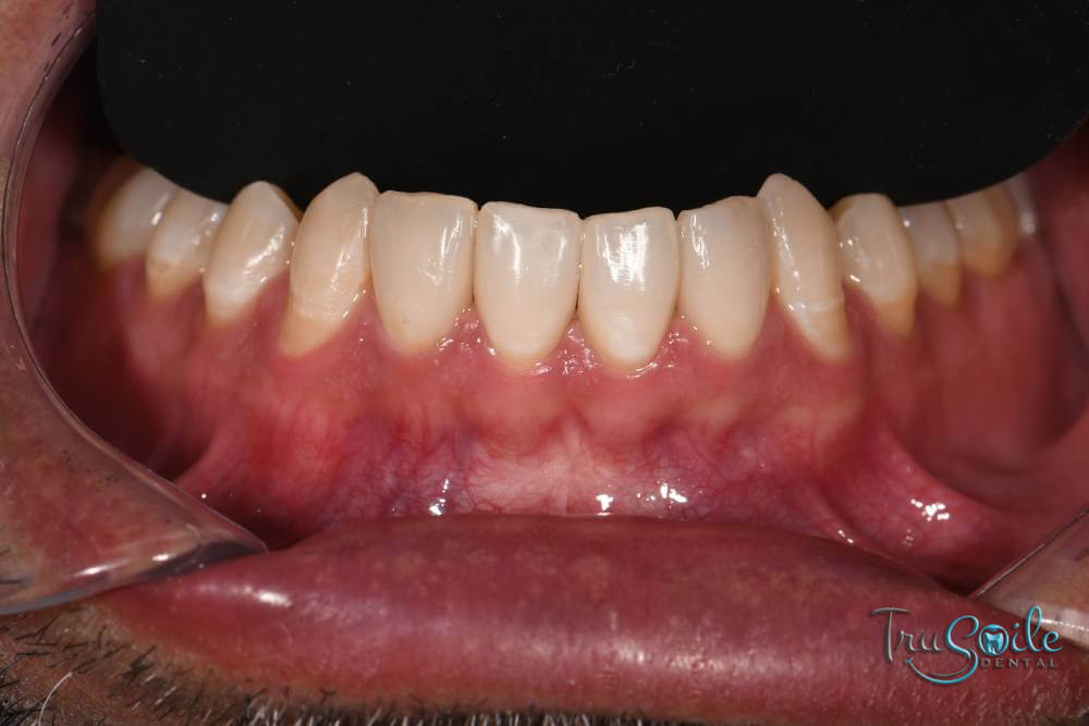 invisalign-with-composite-fillings-img1