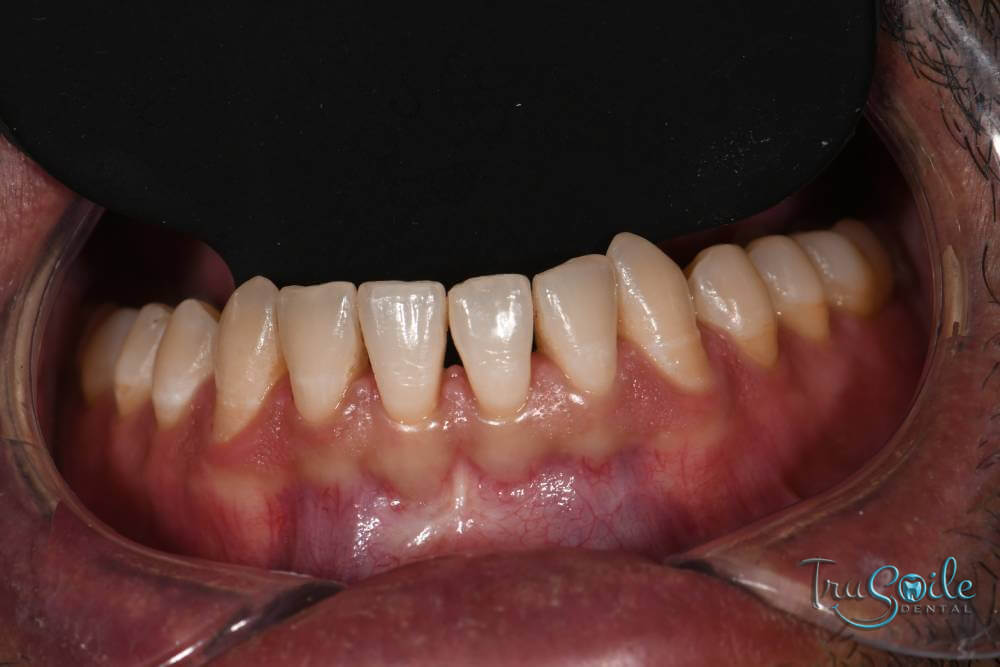 invisalign-with-composite-fillings-img4