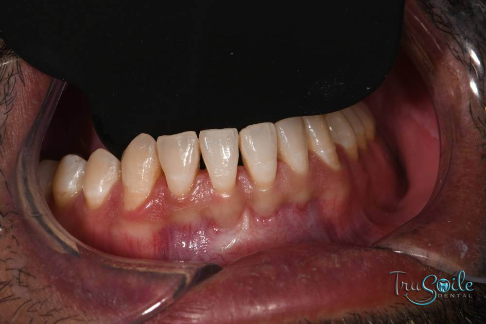 invisalign-with-composite-fillings-img5