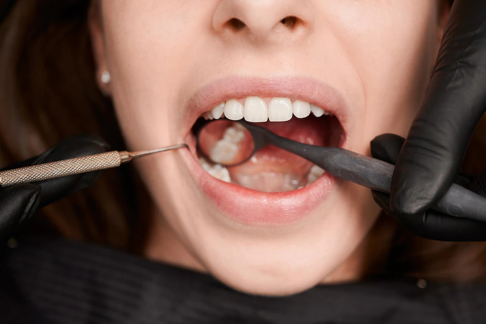 dental cavity prevention in Calgary