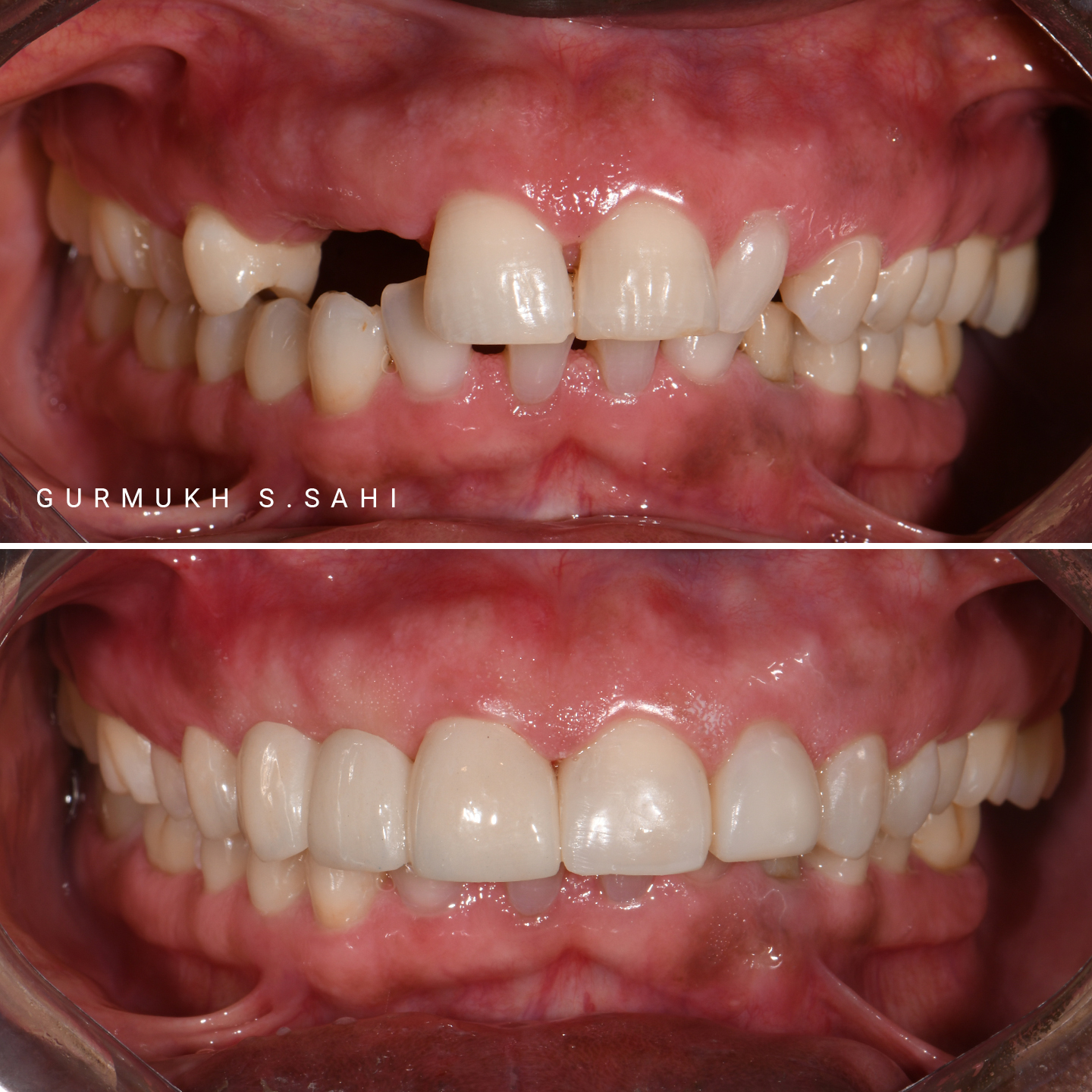 Trusmile-BA-images-case2.1