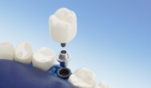 dental implants in calgary