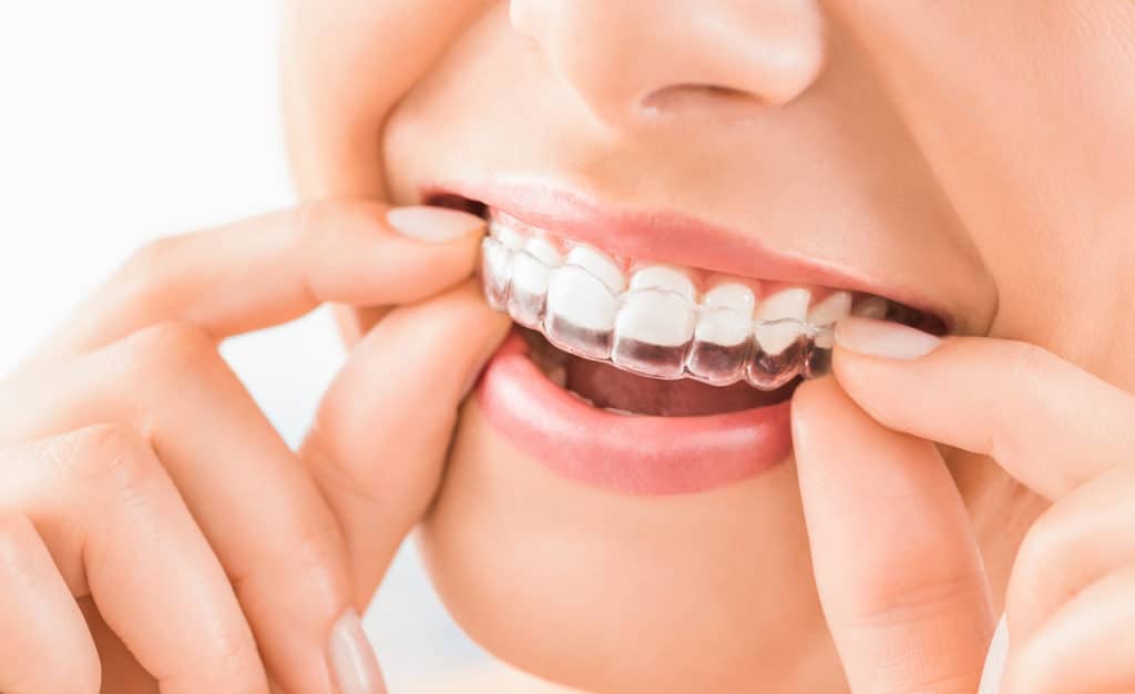 Benefits of adult orthodontics treatment