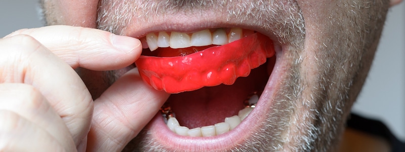 Mouthguard vs. No Mouthguard: The Risk of Dental Injuries