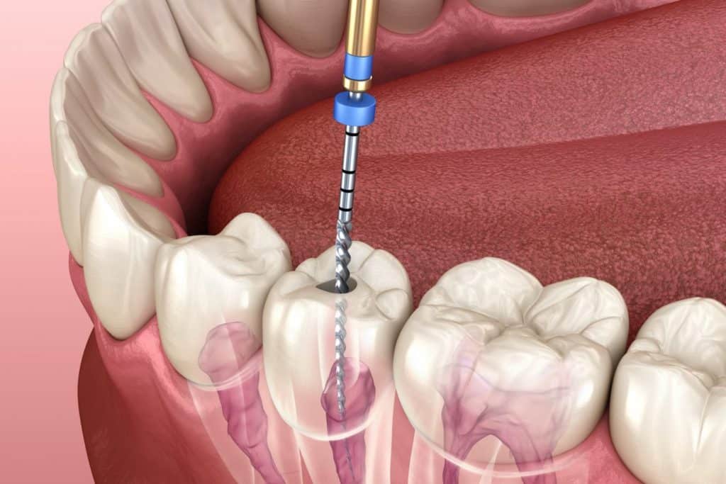 Root-Canal-Treatment