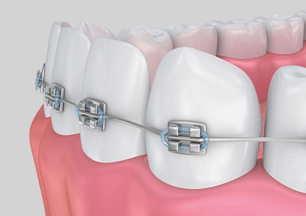 Exploring The World Of Orthodontics in true smile dental