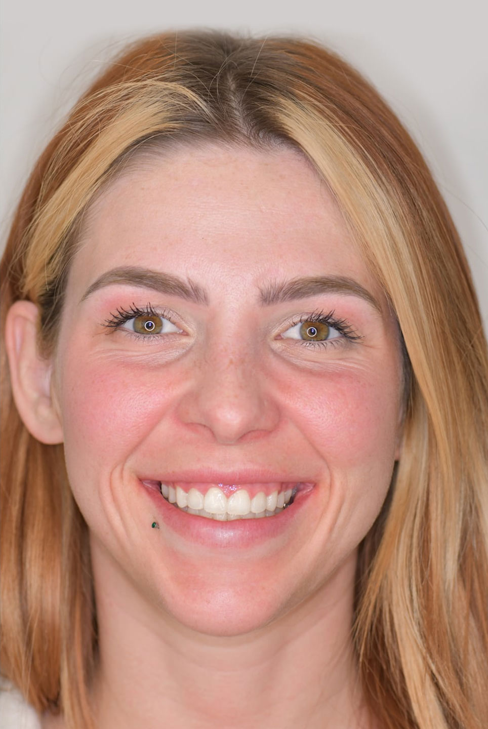 Calgary Dentist BeforeAfter Dental Images TruSmile Dental