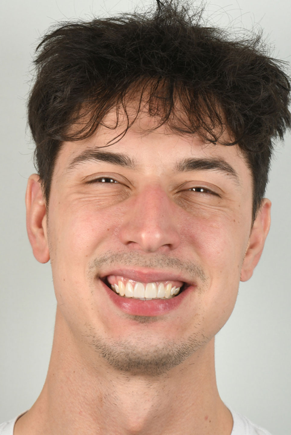 Calgary Dentist BeforeAfter Dental Images TruSmile Dental