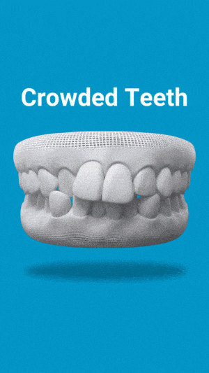 Crowded-Teeth allignment huntington hills, calgary