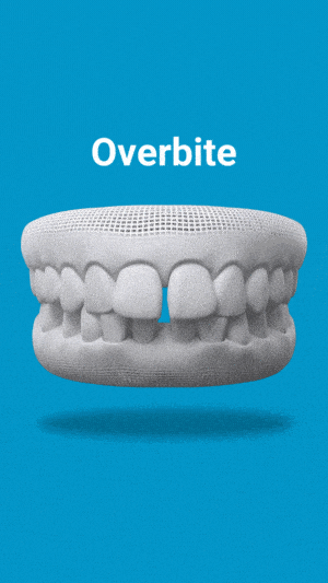 Overbite treatment huntington hills, calgary
