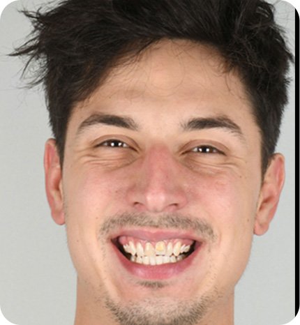before braces treatment results