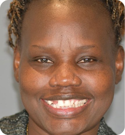 before dental alignment treatment
