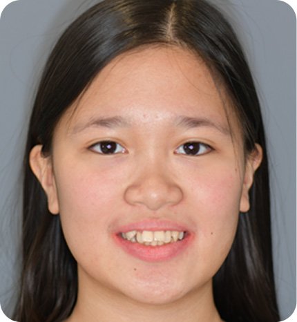 before smile correction treatment