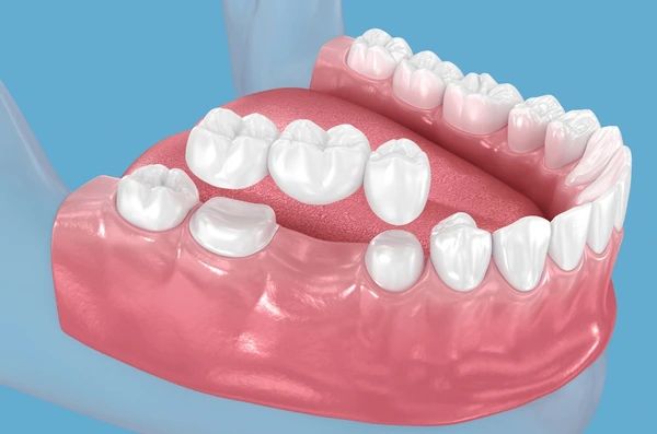 Dental Bridges in Calgary NW | Dental Bridges Near Me
