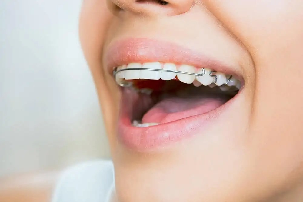 orthodontic hawley retainer for post braces teeth stability