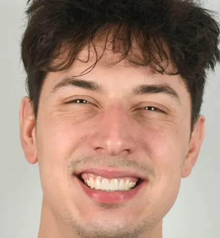 after braces treatment results