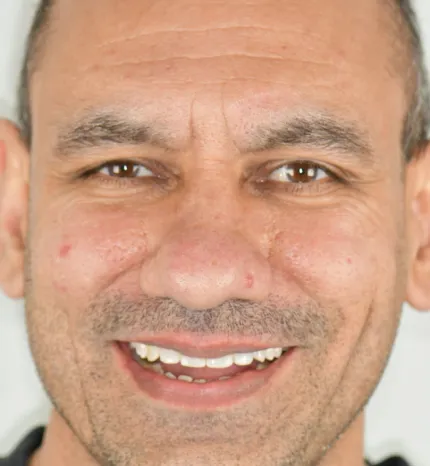 after dental treatment smile